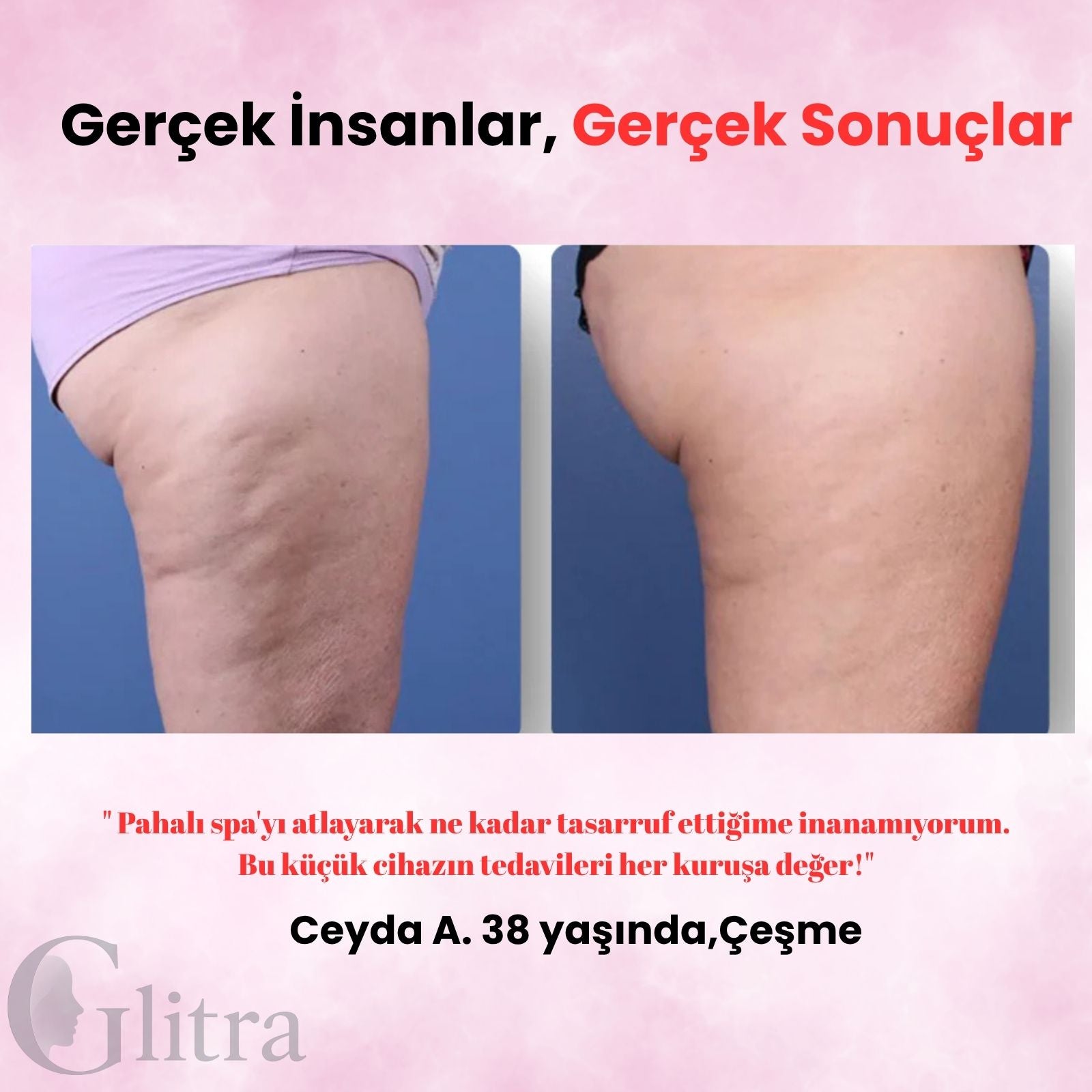 Glitra-Selülit Masaj Aleti