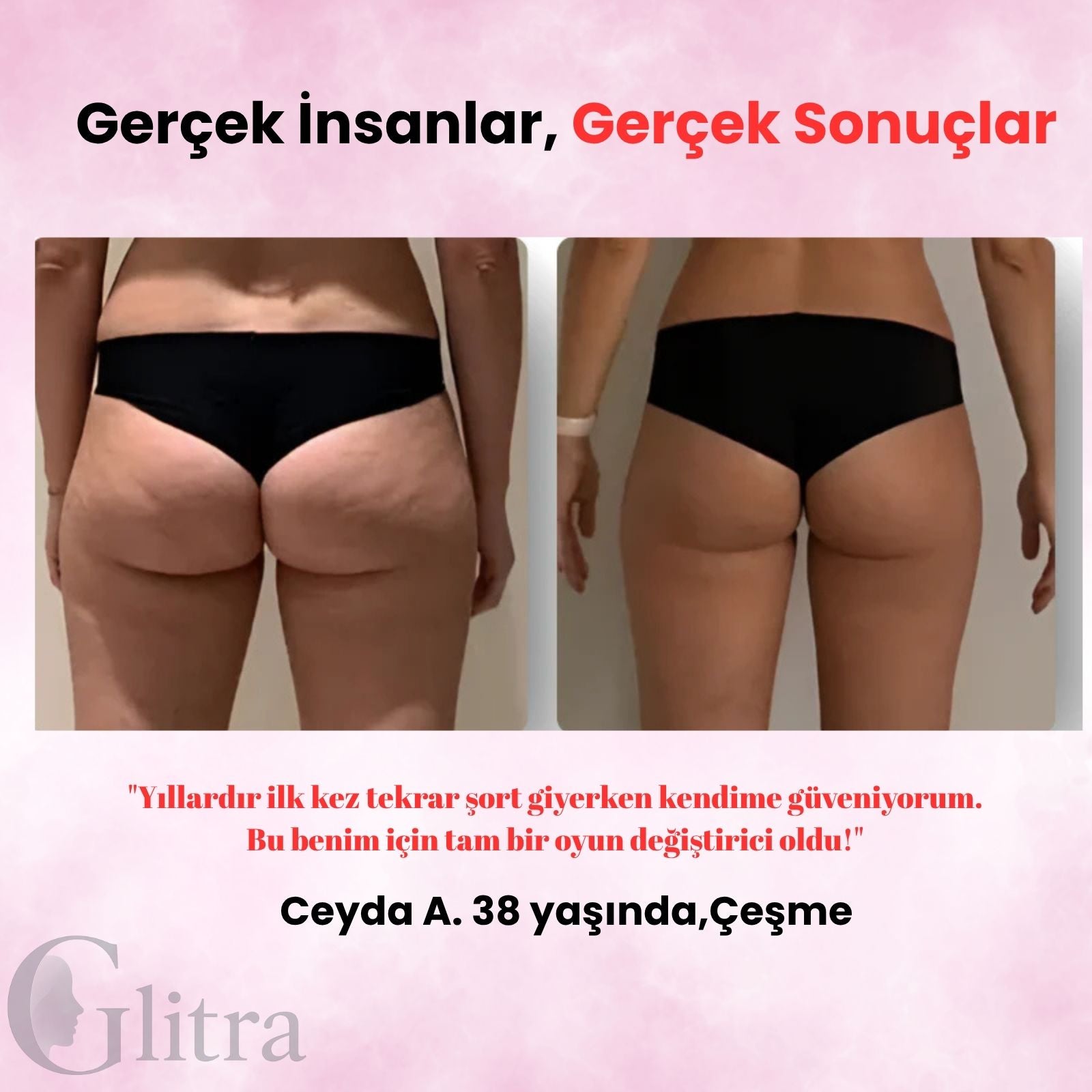 Glitra-Selülit Masaj Aleti